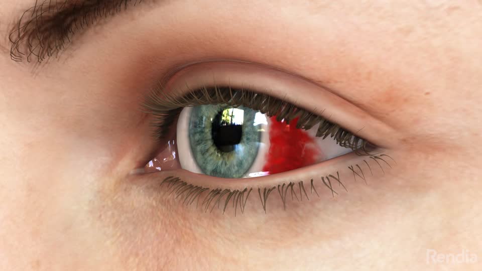Eye bleeding: Types, causes, treatment, and seeking help
