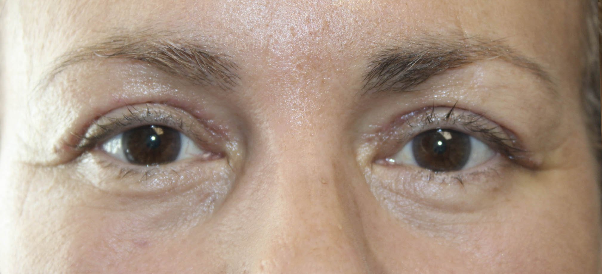 woman 52 years old upper and lower blepharoplasty procedure