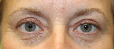 55 year old woman after blepharoplasty results