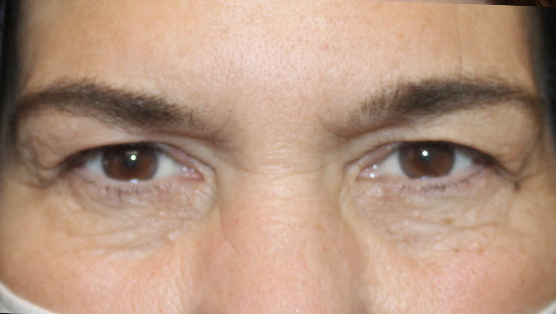 56 year old male frontal facing before blepharoplasty