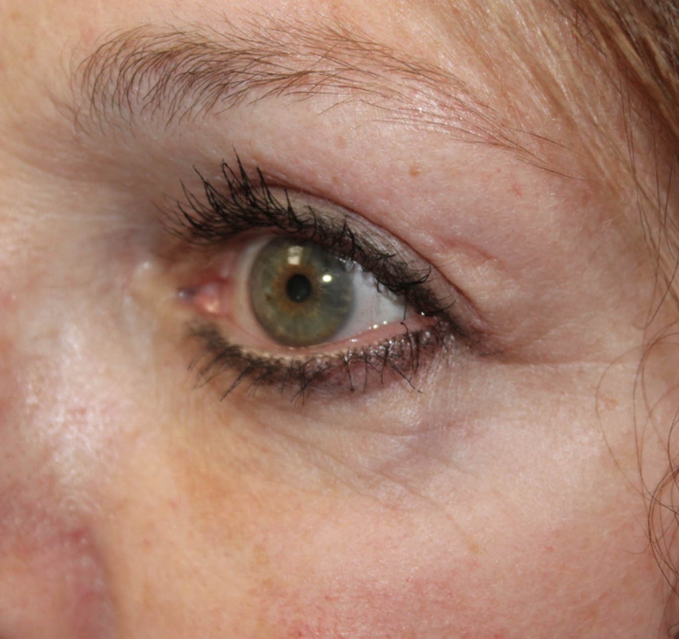 56 year old female left eye after upper blepharoplasty
