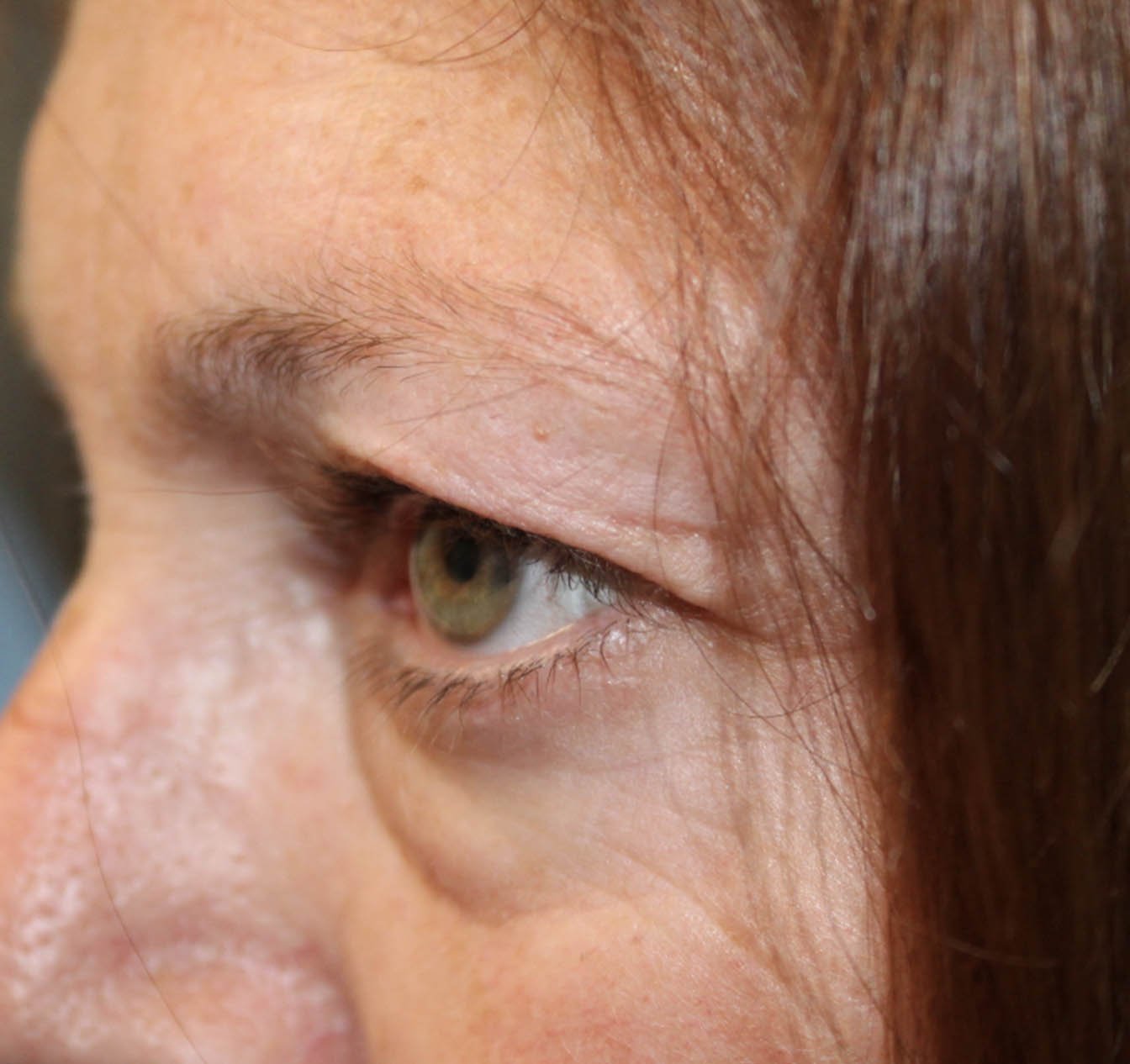 56 year old woman side facing left eye before blepharoplasty