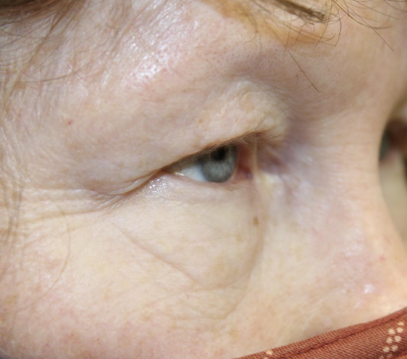 57 year old woman after blepharoplasty lower procedure