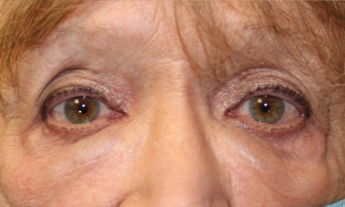 Womans eye before receiving doxycycline