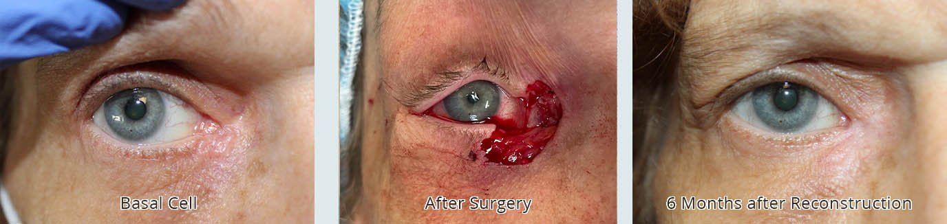 70 year old before during and after the removal of a basal cell inner eye