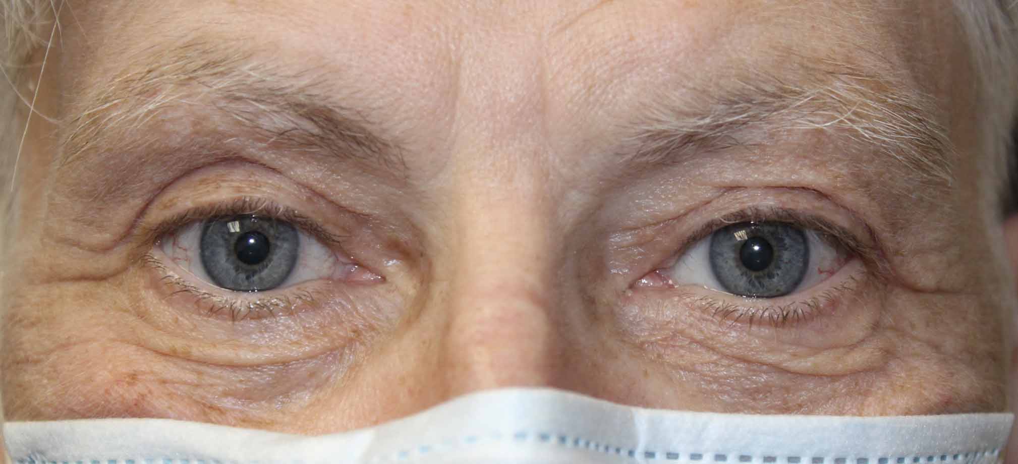 70 year old woman ptosis repair results