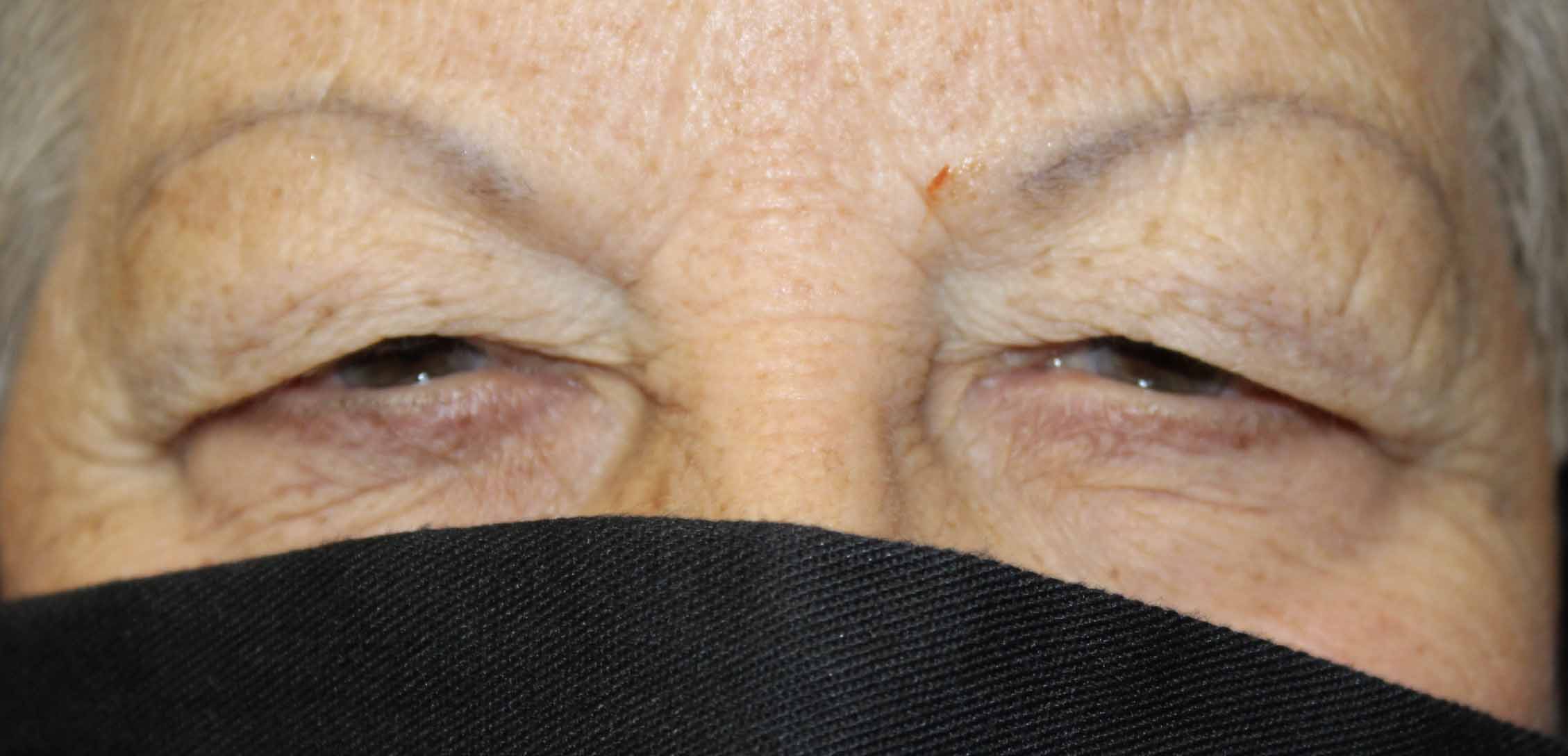 70 year old woman before upper blepharoplasty