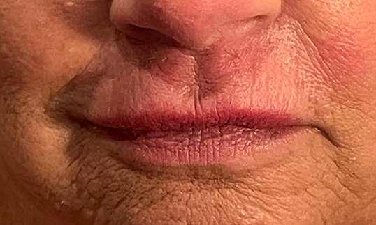 female lips before restylane treatment