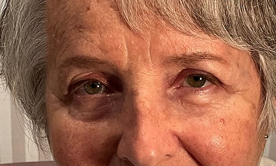 female patient after lower blepharoplasty eye procedure