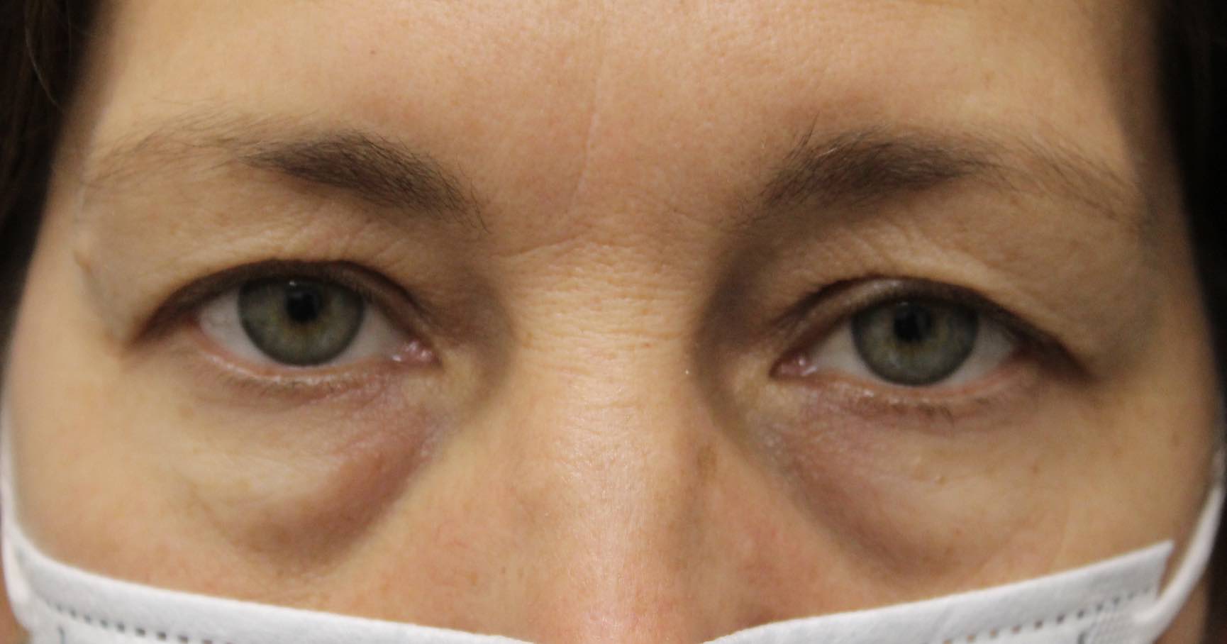 50 year old woman before upper eyelid blepharoplasty