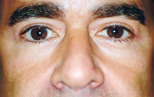 close up of male eyes after blepharoplasty
