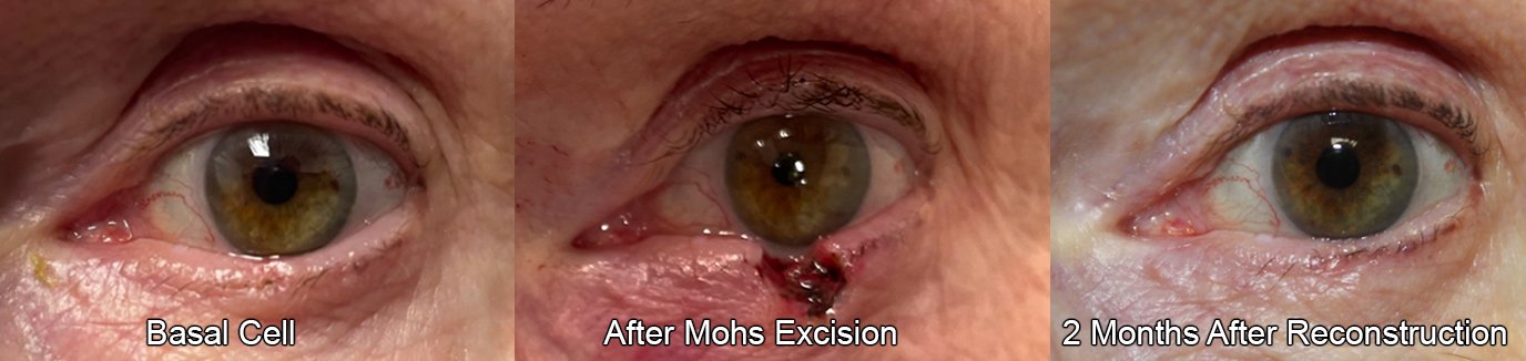 before and after of a basal cell excision on the lower eyelid