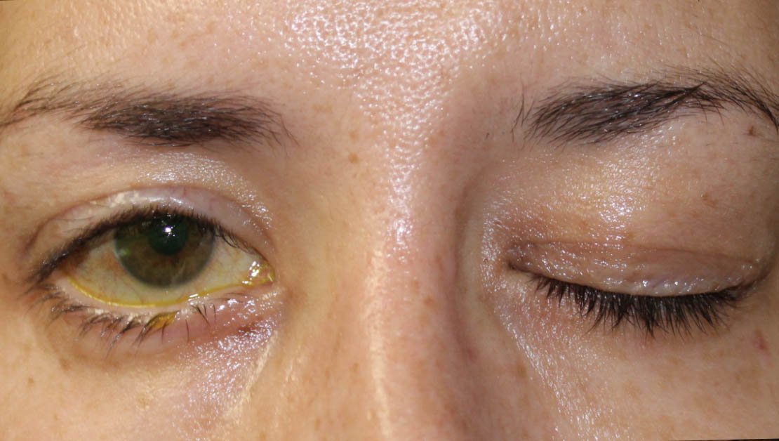 womans eye after receiving facial paralysis surgery